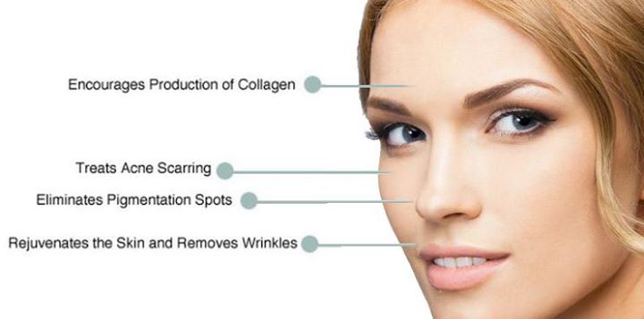 What is Microneedling? 14232560_1251360104894578_5096068906649381475_n