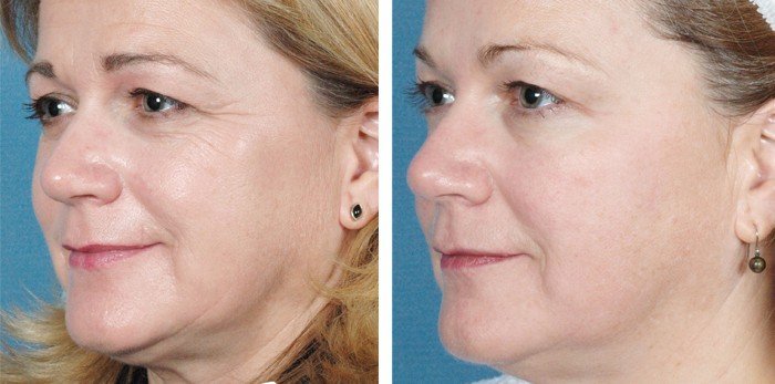 Facial Skin - The Top 7 Tips to Prevent and/or Restore Your Aging Skin Sublime-before-after-700x347-1