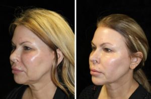 Facelift - The Non-Surgical Way Boston Agnes-Angela-before-After-1024x1024