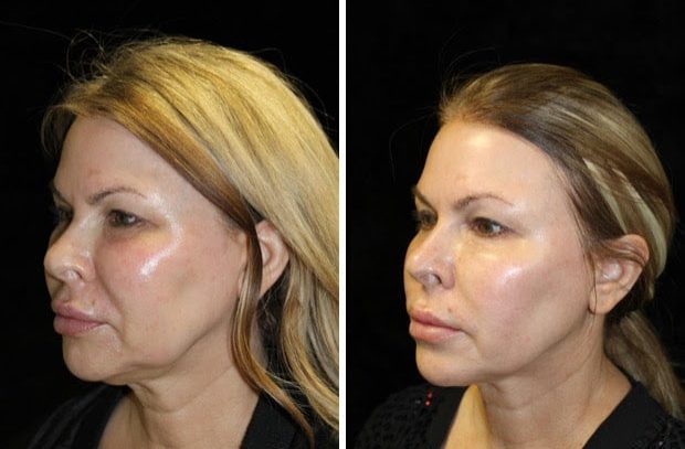 https://www.cosmeticlasersolutions.net/wp-content/uploads/2020/02/Agnes-Scarlet-Combo-e1642020800174.jpg