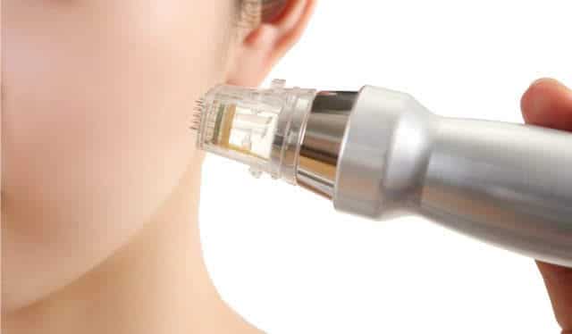 RF Microneedling with Scarlet RF or Morpheus8 ScarletRF-Tip