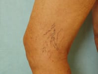 Spider Veins CherryAngiomas