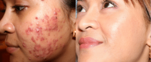 Best Treatments for Acne & Acne Scarring acne-623x258-1-300x124