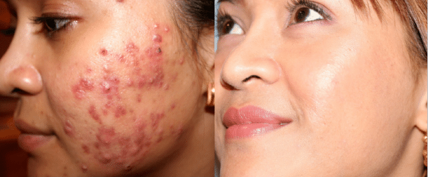 Best Treatments for Acne & Acne Scarring acne-623x258-1