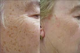 Face Treatments TransfirmSkin