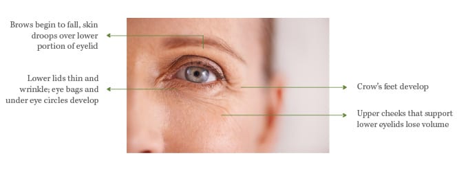 Under Eye Wrinkles, Eye Treatments eye-Wrinkles-laser