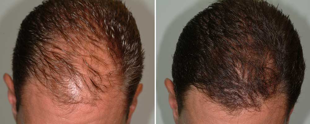 Hair Loss Rejuvenation in the Boston Area PepFactorHairLoss