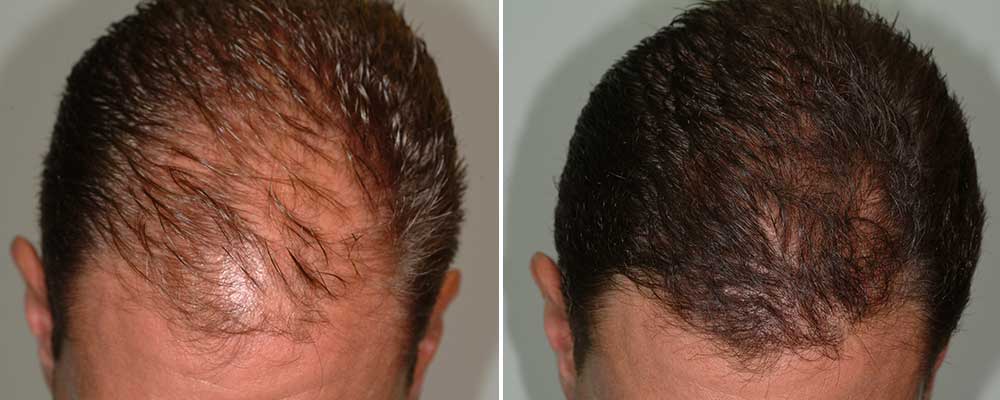 5 Reasons Why Your Hair is Thinning hair-loss-male