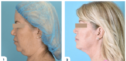 5 Solutions for Double Chin Fat  Removal WomanFaceNeck