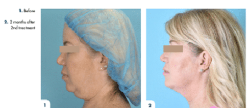 5 Solutions for Double Chin WomanFaceNeck