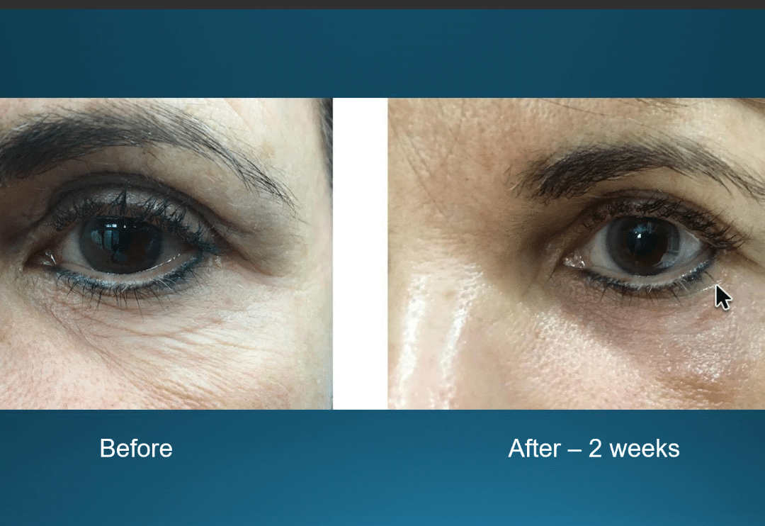 https://www.cosmeticlasersolutions.net/wp-content/uploads/2020/07/Agnes-Under-Eye-Skin-Tightening.png