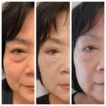 BeautifyMD - Non Surgical Facelift with AgnesRF & ScarletRF Agnes-Jawline-Before-After-150x150