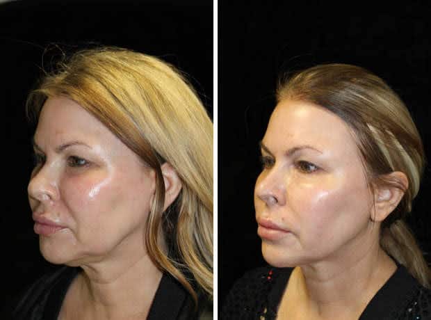 Non-Surgical Facelift Boston woman-facelift-1