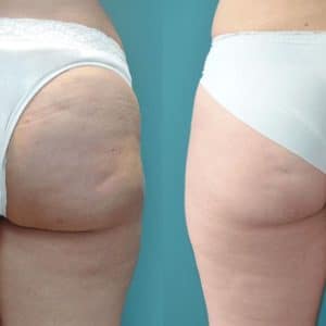 Cellulite Treatment with Exilis Ultra BTL-Cellulite-Reduction-300x300