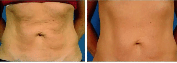 Non-Surgical Options For Body Contouring Exilis-AbdomenSmoothing