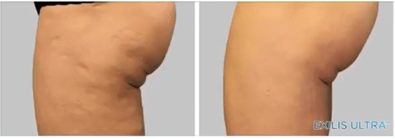 Laser Facial Elite-Facelift-Exilis-Laser-Facial