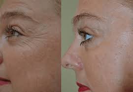 Laser Facial Elite-Facelift-Exilis-Laser-Facial
