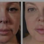 BeautifyMD - Non Surgical Facelift with AgnesRF & ScarletRF Agnes-Jawline-Before-After-150x150