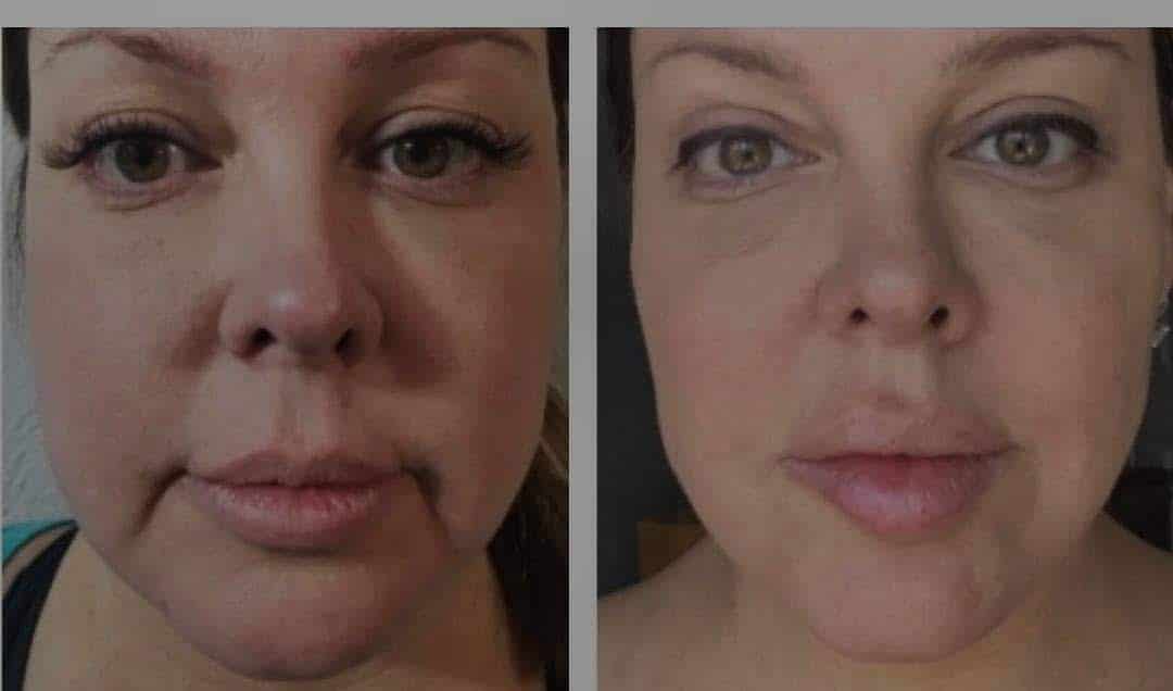 exposure x before after exposure x before after