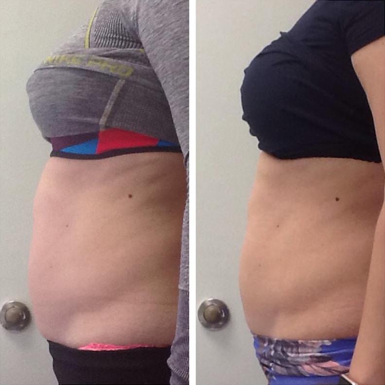 Non-Surgical Options For Body Contouring Exilis-AbdomenSmoothing