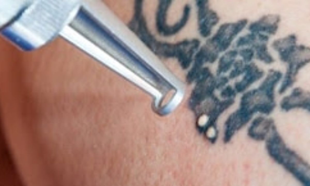 Best Laser Tattoo Removal Specials Near Me | Tattoo Removal Cost Boston MA Best Laser Tattoo Removal Specials Near Me | Tattoo Removal Cost Boston MA