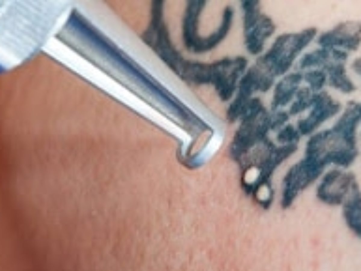 Best Laser Tattoo Removal Specials Near Me | Tattoo Removal Cost Boston MA Best Laser Tattoo Removal Specials Near Me | Tattoo Removal Cost Boston MA