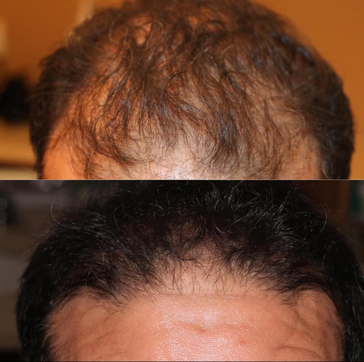 Best Hair Loss Rejuvenation Treatment Boston PepFactorHairLoss