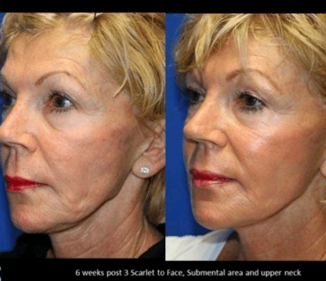 Microneedling Treatment