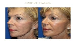 Before and After RF Microneedling Scarlet-Post-3-Sesions-2020-300x165