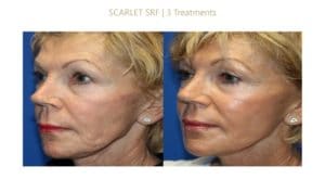 RF Microneedling Scarlet-Post-3-Sesions-2020-300x165