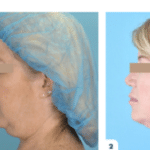 BeautifyMD - Non Surgical Facelift with AgnesRF & ScarletRF Agnes-Jawline-Before-After-150x150