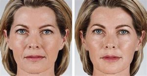 nasolabial correction