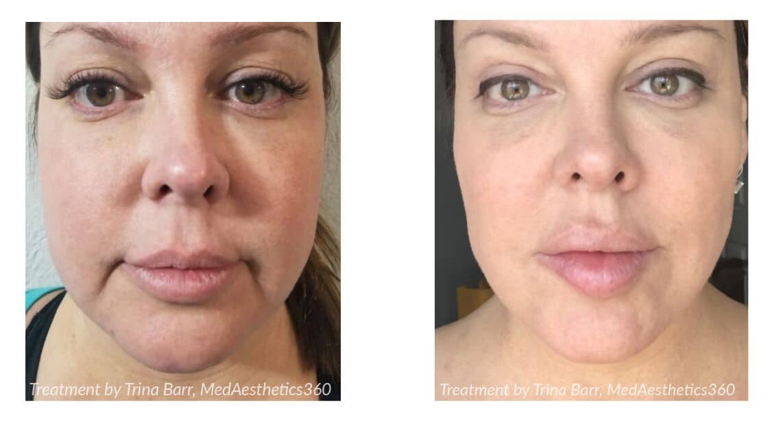https://www.cosmeticlasersolutions.net/wp-content/uploads/2021/06/Agnes-jawline-lift-fat-removal.jpg