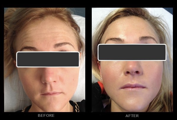 HowMuchBotoxwillINeed-44b7a611 BOTOX® Treatment Near Me BOTOX® Treatment Near Me HowMuchBotoxwillINeed-44b7a611