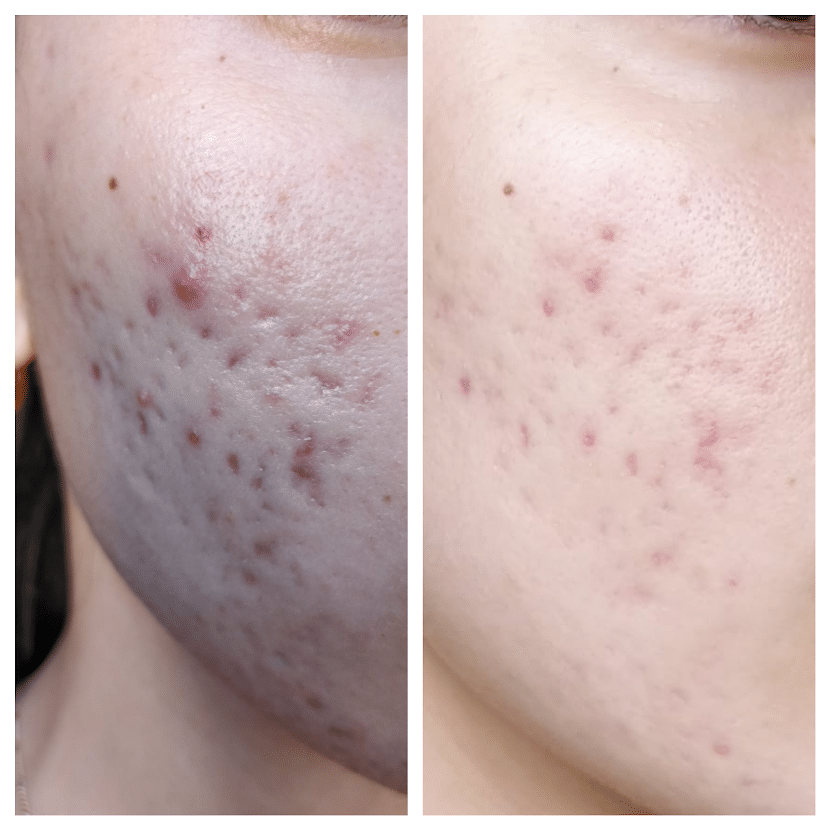 100-GiftCardOffer Laser Treatment Specials Laser Treatment Specials 100-GiftCardOffer