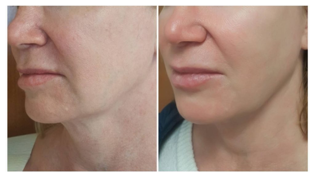 Non-Surgical Facelift Boston woman-facelift-1