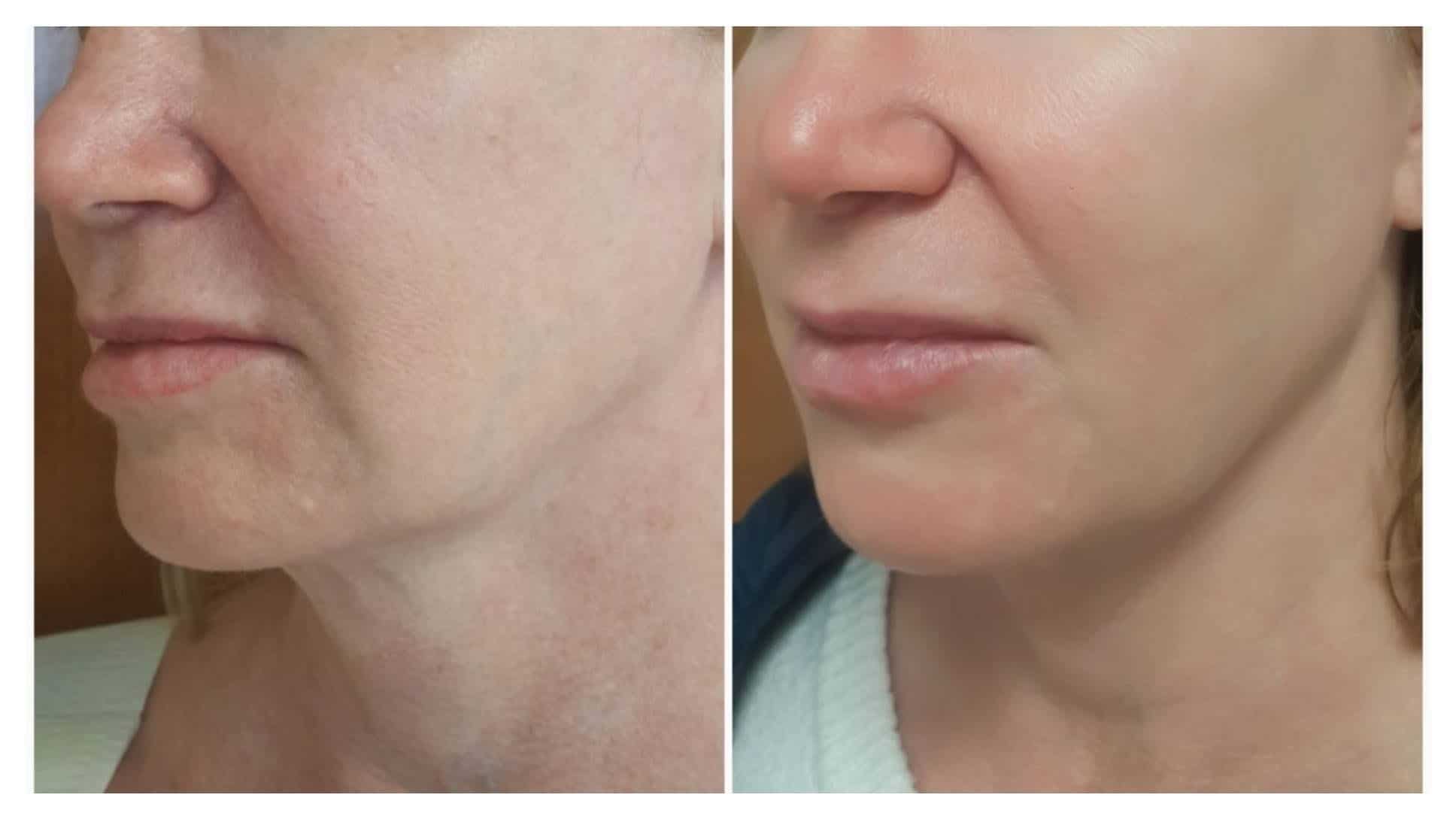 https://www.cosmeticlasersolutions.net/wp-content/uploads/2022/01/AgnesRFBeforeAfterMarrionette-LInes.jpg