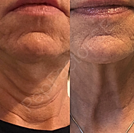 Laser Treatment Specials Woman-In-50s