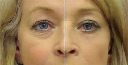 Laser Treatment Special Packages EyeWrinklesTreatmentBoston