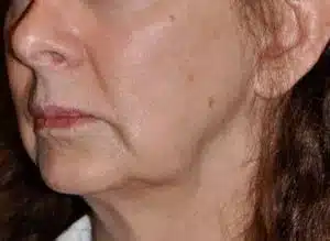 AGNES RF Microneedling UnderEyeWrinkles