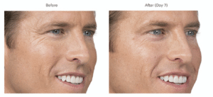 HowMuchBotoxwillINeed-44b7a611 BOTOX® Treatment Near Me BOTOX® Treatment Near Me HowMuchBotoxwillINeed-44b7a611