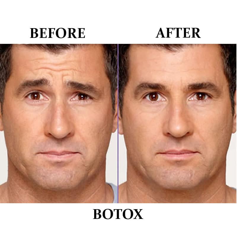 BOTOX® Treatment Near Me HowMuchBotoxwillINeed-44b7a611